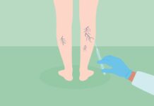 Склеротерапія: Керівництво по лікуванню судинних зірочок і варикозного розширення вен