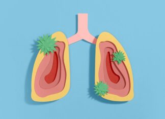 Тяжкі Респіраторні Інфекції Пов’язані з Підвищеним Ризиком Рака Легких