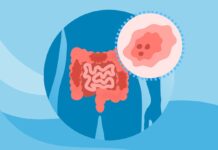 Зростаюча кількість випадків колоректального раку в ранньому віці: що вам потрібно знати