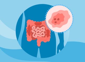 Зростаюча кількість випадків колоректального раку в ранньому віці: що вам потрібно знати