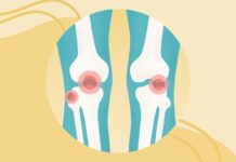 Остеоартрит Коленного Сустава: Полное Руководство по Симптомам, Лечению и Профилактике