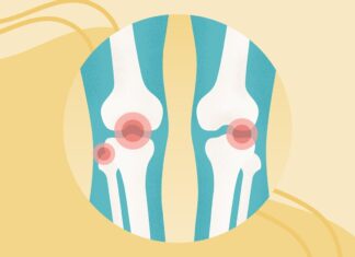 Остеоартрит Коленного Сустава: Полное Руководство по Симптомам, Лечению и Профилактике