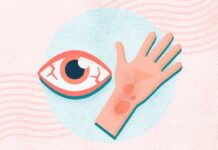 Understanding Allergies: Causes, Symptoms, and Management Strategies