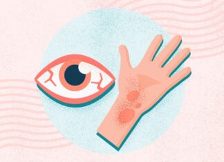 Все об аллергии: причины, симптомы и стратегии контроля