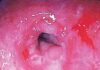 Why GERD Happens and How to Stop Acid Reflux Naturally